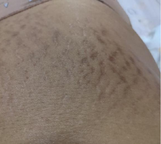 哺乳期能祛除妊娠纹吗，什么方法较有