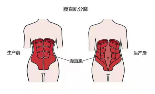  产后先修复盆底肌还是腹直肌
