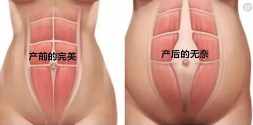 产后腹直肌分离，需要做修复吗？