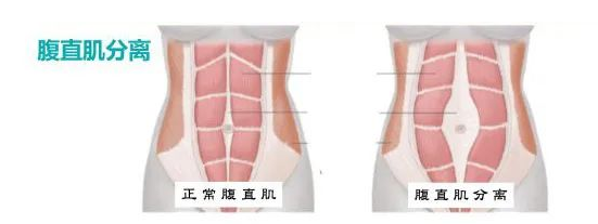 产后多长时间适合做腹直肌修复