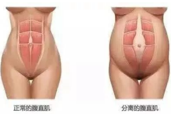 产后修复腹直肌能起到什么果