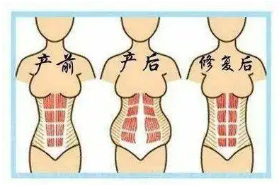 剖腹产后多久可以腹直肌修复